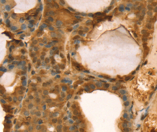 Immunohistochemistry of paraffin-embedded Human thyroid cancer using TAF11 Polyclonal Antibody at dilution of 1:40