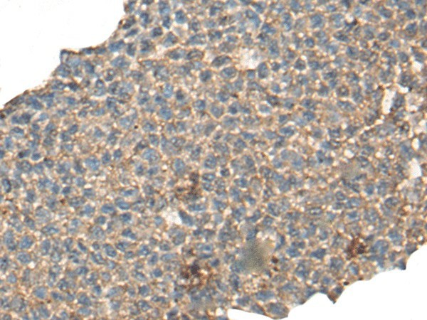 Immunohistochemistry of paraffin-embedded Human ovarian cancer tissue  using CABP5 Polyclonal Antibody at dilution of 1:65(?200)