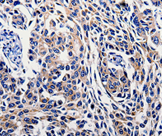 Immunohistochemistry of paraffin-embedded Human lung cancer tissue using IL10RB Polyclonal Antibody at dilution 1:60