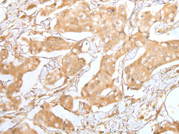 Immunohistochemistry of paraffin-embedded Human breast cancer tissue  using GRAP Polyclonal Antibody at dilution of 1:40(?200)