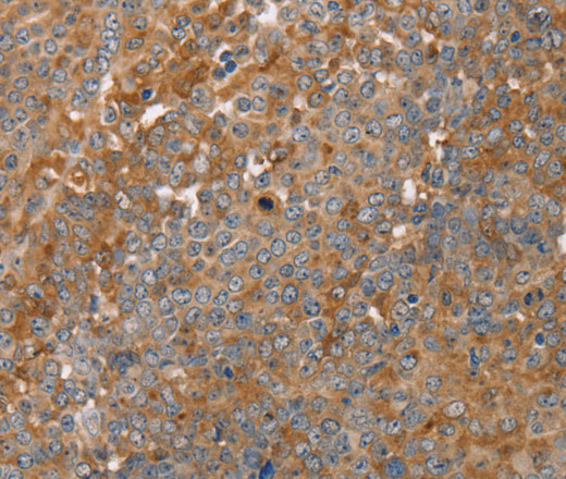 Immunohistochemistry of paraffin-embedded Human ovarian cancer using FAIM2 Polyclonal Antibody at dilution of 1:30