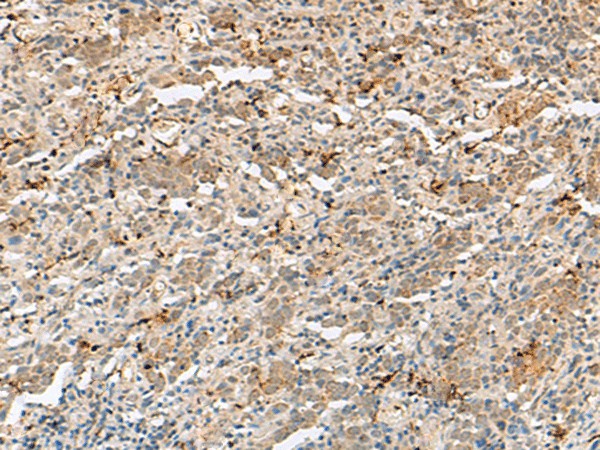 Immunohistochemistry of paraffin-embedded Human cervical cancer tissue  using H3F3B Polyclonal Antibody at dilution of 1:40(?200)