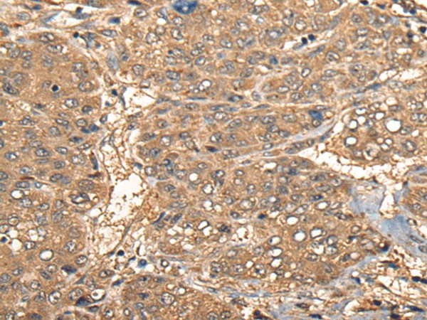 Immunohistochemistry of paraffin-embedded Human liver cancer tissue  using CCL27 Polyclonal Antibody at dilution of 1:55(?200)