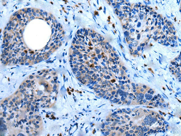 Immunohistochemistry of paraffin-embedded Human cervical cancer tissue  using WISP2 Polyclonal Antibody at dilution of 1:45(?200)