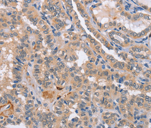 Immunohistochemistry of paraffin-embedded Human thyroid cancer tissue using CD36 Polyclonal Antibody at dilution 1:60