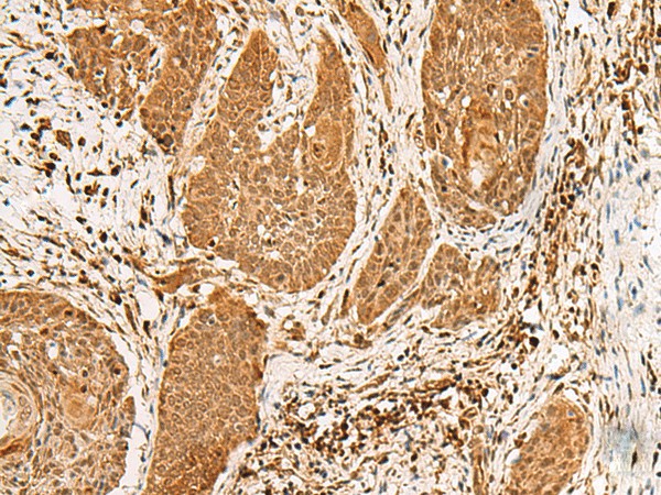 Immunohistochemistry of paraffin-embedded Human esophagus cancer tissue  using PPOX Polyclonal Antibody at dilution of 1:30(?200)