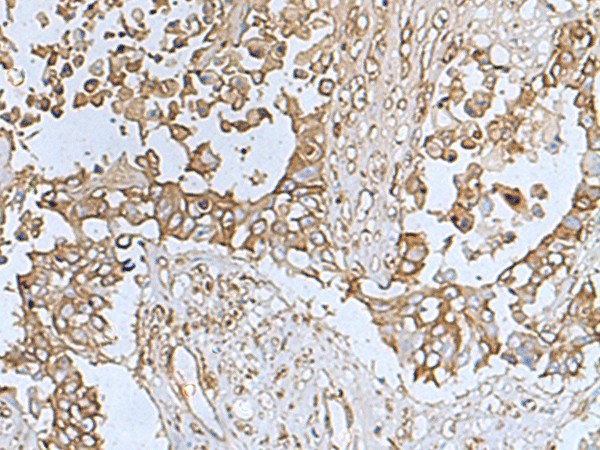 Immunohistochemistry of paraffin-embedded Human colorectal cancer tissue  using TREM1 Polyclonal Antibody at dilution of 1:50(?200)