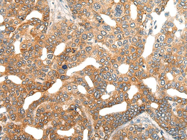 Immunohistochemistry of paraffin-embedded Human liver cancer tissue  using HIPK2 Polyclonal Antibody at dilution of 1:40(?200)