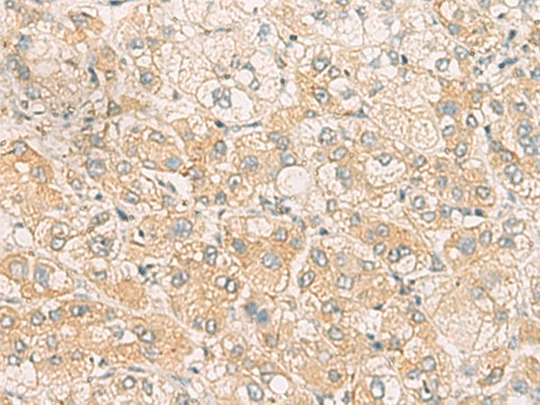 Immunohistochemistry of paraffin-embedded Human liver cancer tissue  using SYNGR1 Polyclonal Antibody at dilution of 1:60(?200)