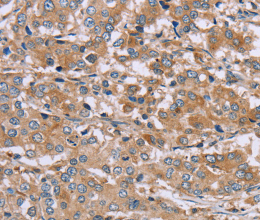 Immunohistochemistry of paraffin-embedded Human liver cancer tissue using NDRG3 Polyclonal Antibody at dilution 1:40