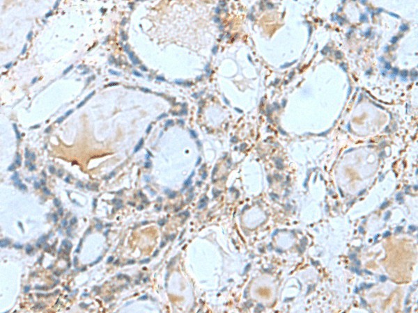 Immunohistochemistry of paraffin-embedded Human thyroid cancer tissue  using GPCPD1 Polyclonal Antibody at dilution of 1:50(?200)