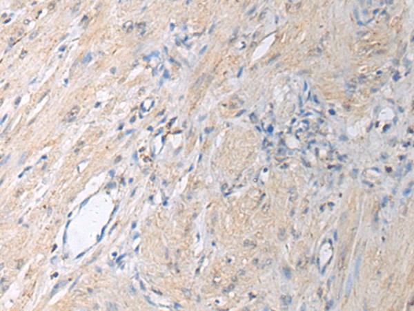 Immunohistochemistry of paraffin-embedded Human gastric cancer tissue  using GNAI1 Polyclonal Antibody at dilution of 1:130(?200)