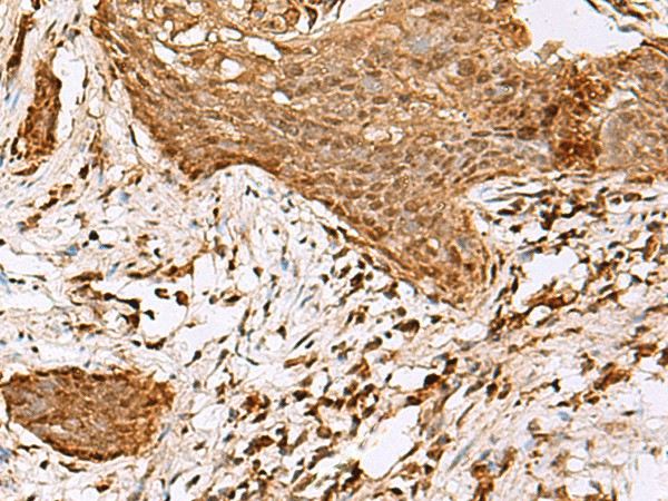 Immunohistochemistry of paraffin-embedded Human esophagus cancer tissue  using SAMSN1 Polyclonal Antibody at dilution of 1:80(?200)