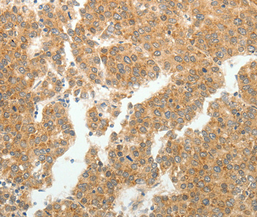 Immunohistochemistry of paraffin-embedded Human liver cancer tissue using GEMIN2 Polyclonal Antibody at dilution 1:40