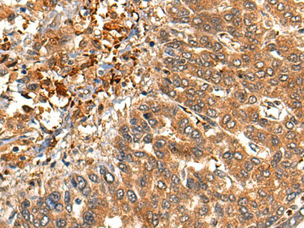 Immunohistochemistry of paraffin-embedded Human liver cancer tissue  using MARK3 Polyclonal Antibody at dilution of 1:40(?200)