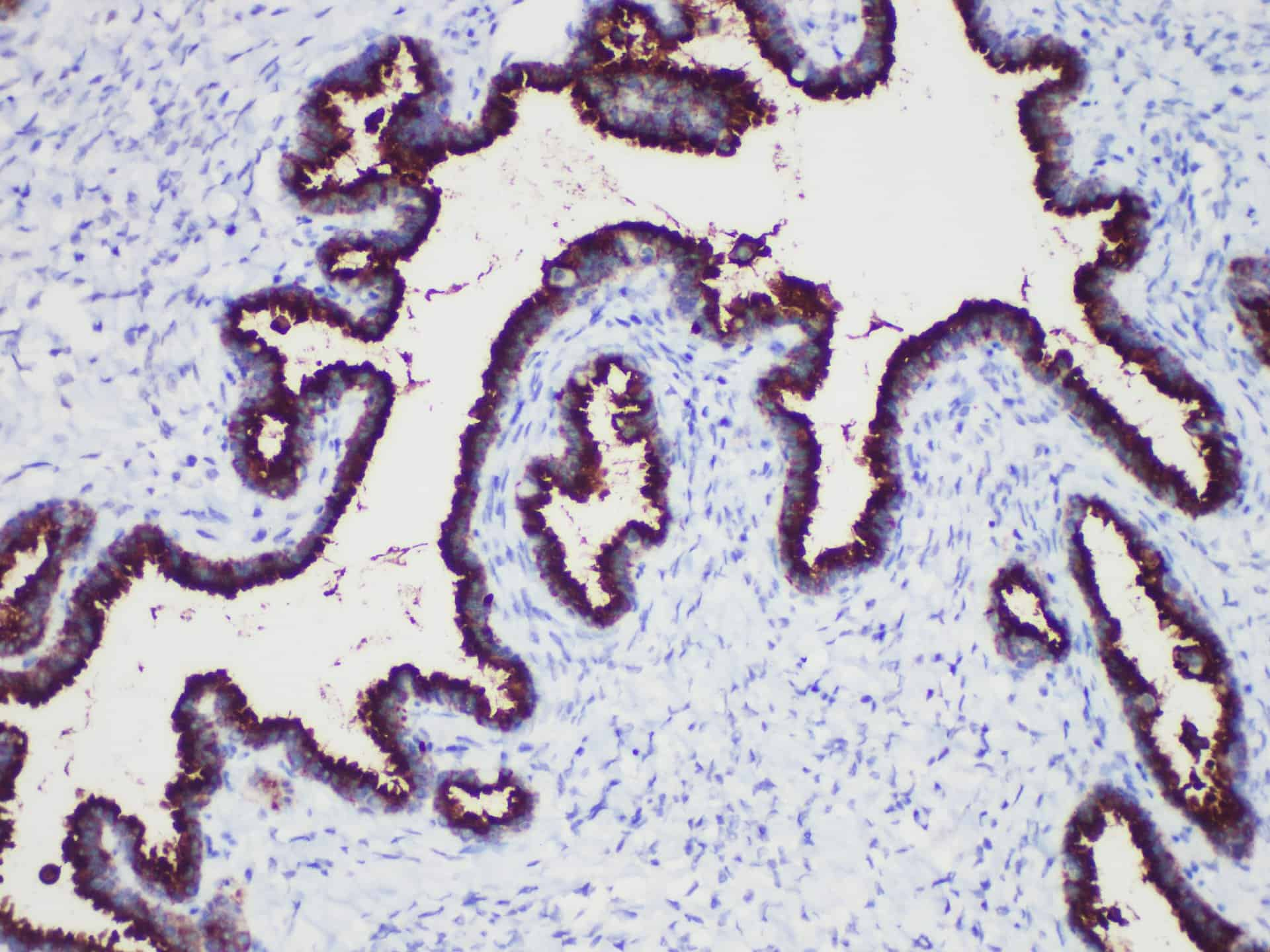 Immunohistochemistry of paraffinembedded Human ovarian cancer with CA-125 Monoclonal Antibody(Antigen repaired by EDTA).