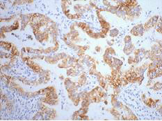 Immunohistochemistry of paraffin-embedded Human lung cancer tissue using CK-7 Monoclonal Antibody at dilution of 1:200.