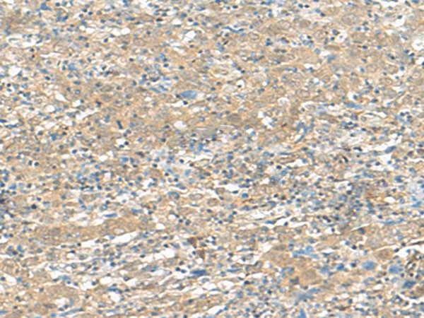 Immunohistochemistry of paraffin-embedded Human cervical cancer tissue  using HMBOX1 Polyclonal Antibody at dilution of 1:30(?200)