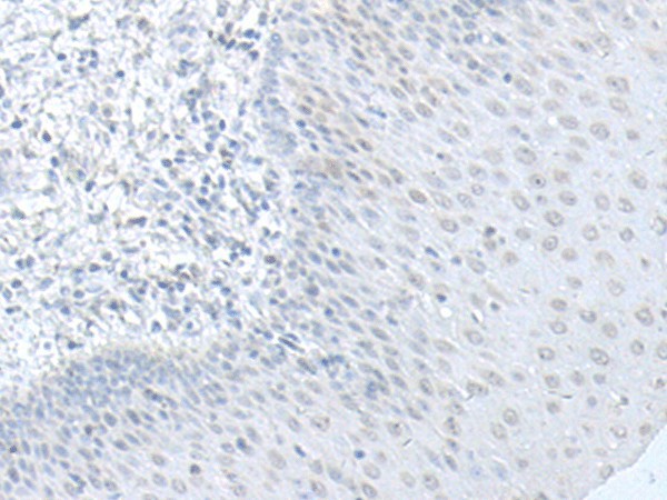 Immunohistochemistry of paraffin-embedded Human esophagus cancer tissue  using C8orf4 Polyclonal Antibody at dilution of 1:70(?200)