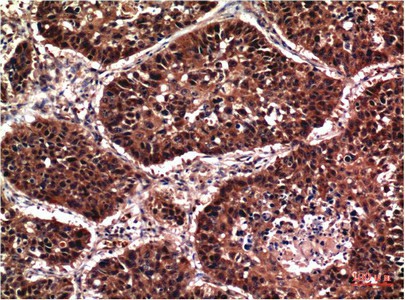 Immunohistochemistry of paraffin-embedded Human lung carcinoma tissue using Phospho-AKT1 (Ser473) Monoclonal Antibody at dilution of 1:200.