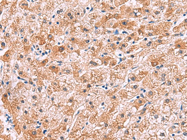 Immunohistochemistry of paraffin-embedded Human liver cancer tissue  using IL4R Polyclonal Antibody at dilution of 1:45(?200)