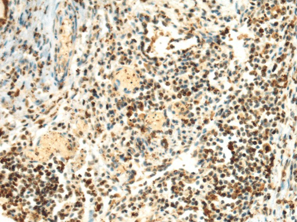 Immunohistochemistry of paraffin-embedded Human lung cancer tissue  using SEPHS1 Polyclonal Antibody at dilution of 1:85(?200)