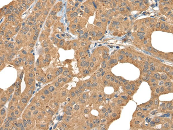 Immunohistochemistry of paraffin-embedded Human thyroid cancer tissue  using BOLA1 Polyclonal Antibody at dilution of 1:35(?200)