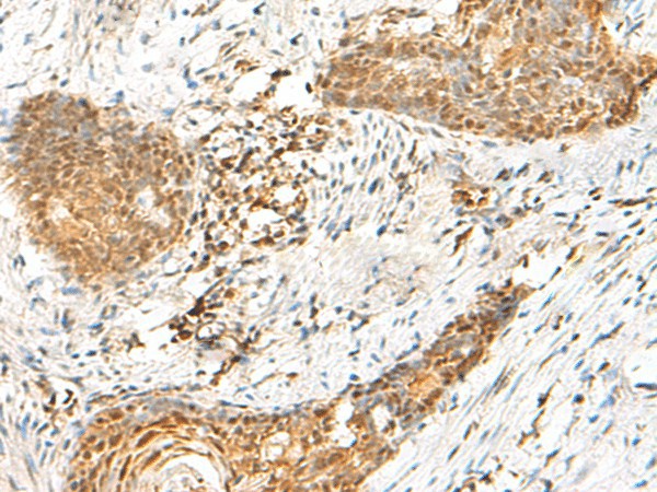 Immunohistochemistry of paraffin-embedded Human esophagus cancer tissue  using HMBOX1 Polyclonal Antibody at dilution of 1:60(?200)