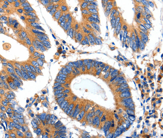 Immunohistochemistry of paraffin-embedded Human colon cancer tissue using IGFBP7 Polyclonal Antibody at dilution 1:50