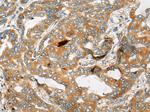 Immunohistochemistry of paraffin-embedded Human liver cancer tissue  using CHCHD3 Polyclonal Antibody at dilution of 1:25(?200)