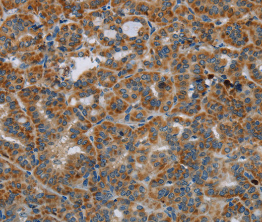 Immunohistochemistry of paraffin-embedded Human thyroid cancer tissue using HSD17B14 Polyclonal Antibody at dilution 1:40