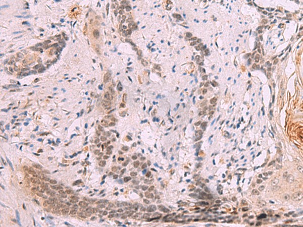 Immunohistochemistry of paraffin-embedded Human esophagus cancer tissue  using INO80 Polyclonal Antibody at dilution of 1:70(?200)