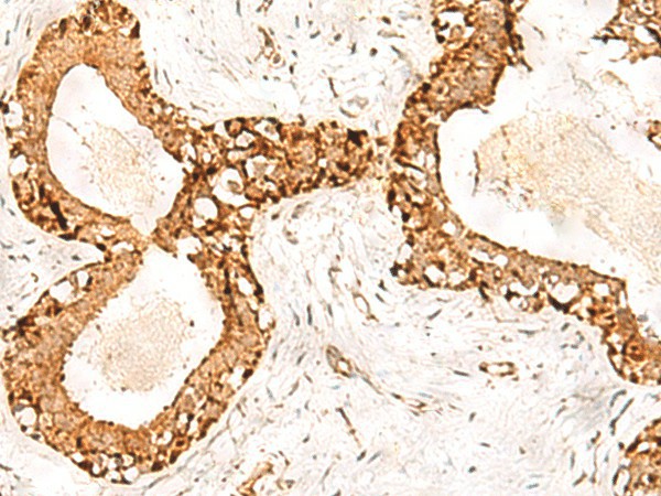 Immunohistochemistry of paraffin-embedded Human breast cancer tissue  using POLH Polyclonal Antibody at dilution of 1:60(?200)