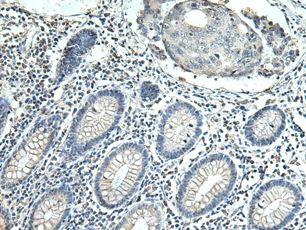 Immunohistochemistry of paraffin-embedded Human colorectal cancer tissue  using SLC35F6 Polyclonal Antibody at dilution of 1:115(?200)