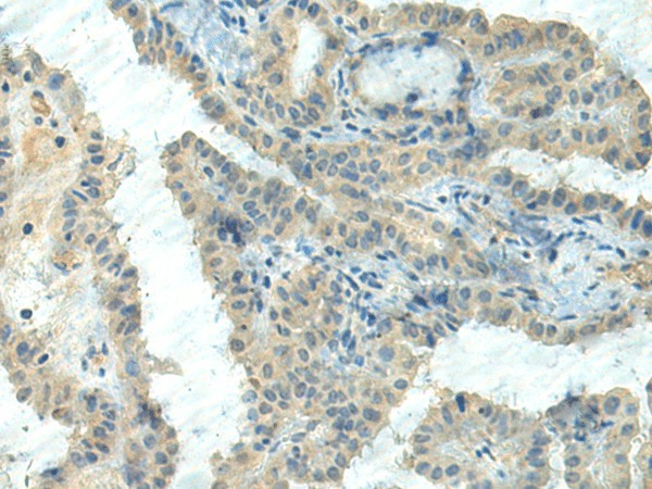 Immunohistochemistry of paraffin-embedded Human thyroid cancer tissue  using CTDP1 Polyclonal Antibody at dilution of 1:55(?200)