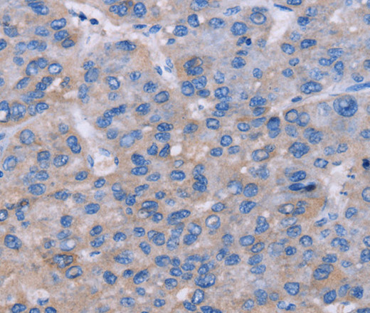 Immunohistochemistry of paraffin-embedded Human liver cancer tissue using NR1D1 Polyclonal Antibody at dilution 1:60