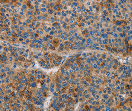 Immunohistochemistry of paraffin-embedded Human liver cancer using AMBP Polyclonal Antibody at dilution of 1:55