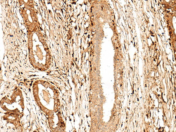 Immunohistochemistry of paraffin-embedded Human breast cancer tissue  using GPR27 Polyclonal Antibody at dilution of 1:60(?200)