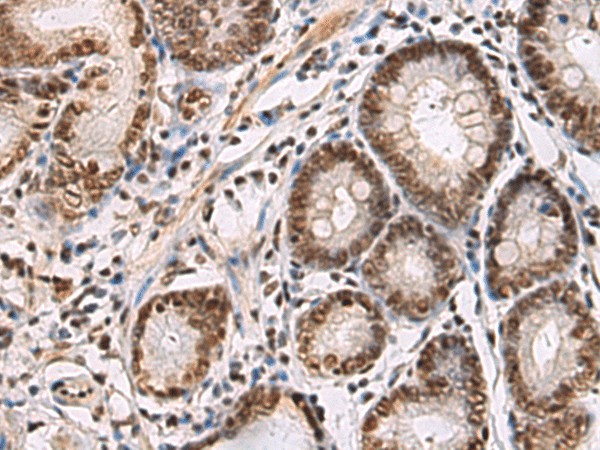 Immunohistochemistry of paraffin-embedded Human gastric cancer tissue  using CREBBP Polyclonal Antibody at dilution of 1:60(?200)