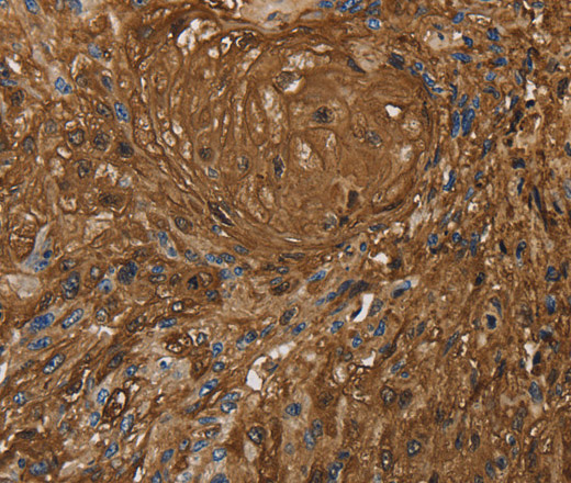 Immunohistochemistry of paraffin-embedded Human esophagus cancer tissue using ITPR3 Polyclonal Antibody at dilution 1:30