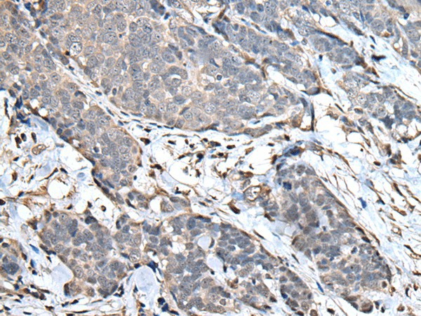 Immunohistochemistry of paraffin-embedded Human thyroid cancer tissue  using UPK3A Polyclonal Antibody at dilution of 1:30(?200)