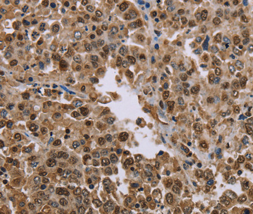 Immunohistochemistry of paraffin-embedded Human liver cancer tissue using MRGPRX1 Polyclonal Antibody at dilution 1:40