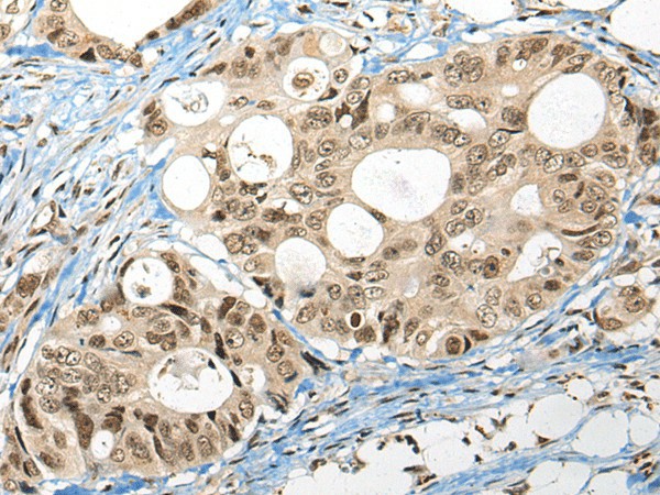 Immunohistochemistry of paraffin-embedded Human colorectal cancer tissue  using FUT4 Polyclonal Antibody at dilution of 1:40(?200)