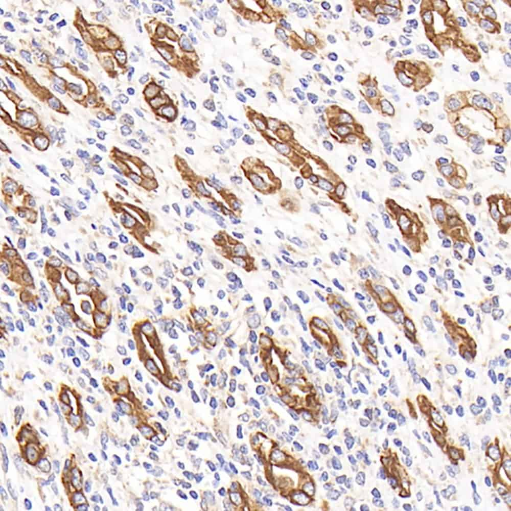 Immunohistochemistry analysis of paraffin-embedded human stomach cancer  using CK-7 Monoclonal Antibody at dilution of 1:300.