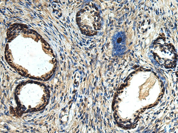 Immunohistochemistry of paraffin-embedded Human prost ate cancer tissue  using ERLIN1 Polyclonal Antibody at dilution of 1:50(?200)