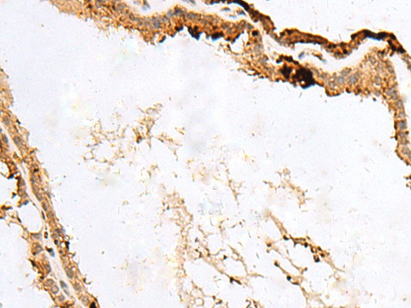 Immunohistochemistry of paraffin-embedded Human thyroid cancer tissue  using RABGGTA Polyclonal Antibody at dilution of 1:50(?200)