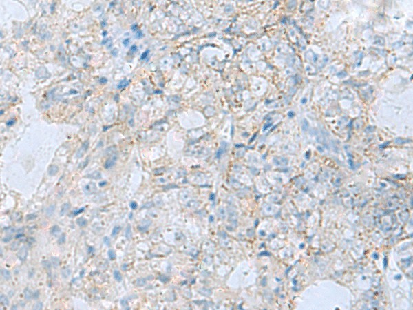 Immunohistochemistry of paraffin-embedded Human ovarian cancer tissue  using PYCR2 Polyclonal Antibody at dilution of 1:35(?200)