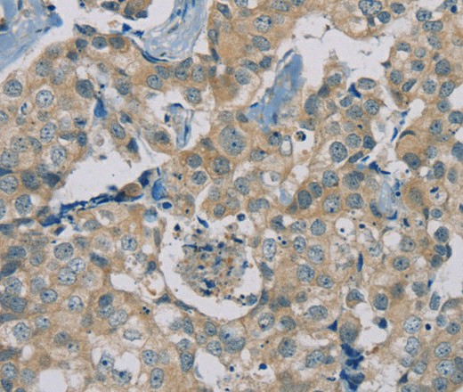 Immunohistochemistry of paraffin-embedded Human breast cancer using RAD51 Polyclonal Antibody at dilution of 1:40