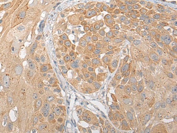 Immunohistochemistry of paraffin-embedded Human esophagus cancer tissue  using SNX6 Polyclonal Antibody at dilution of 1:50(?200)