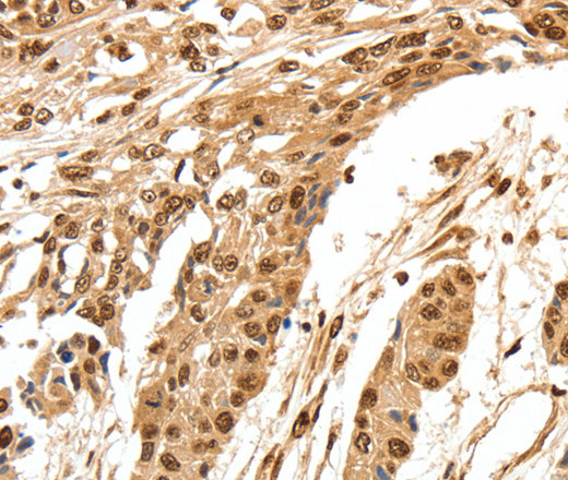 Immunohistochemistry of paraffin-embedded Human esophagus cancer using SPATA20 Polyclonal Antibody at dilution of 1:70